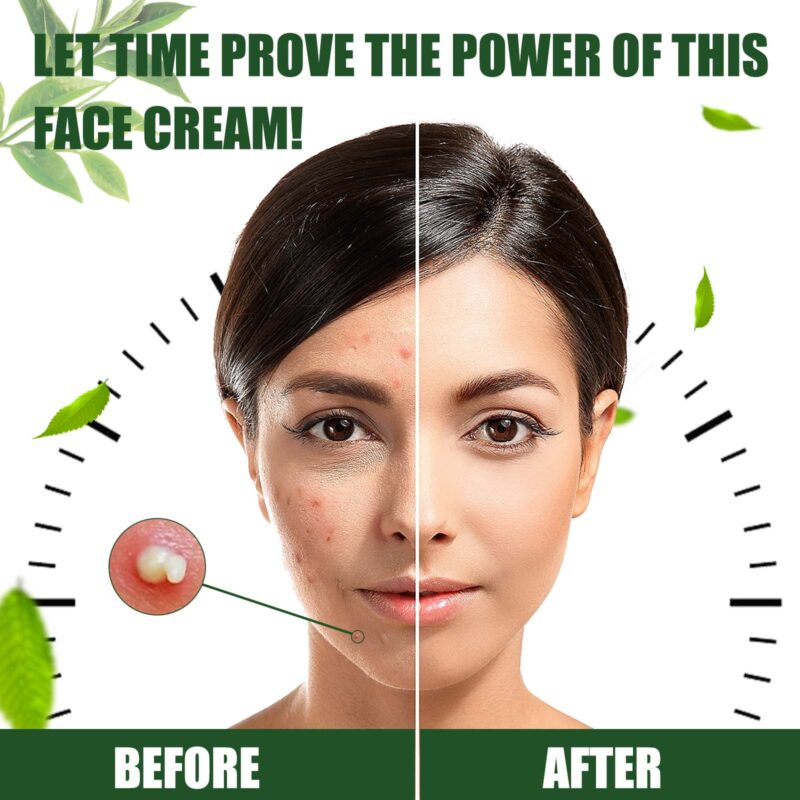 Gentle Daily Care Cream - Acne Soothing Treatment, Fade Marks, Soft Glow Skin - Image 3